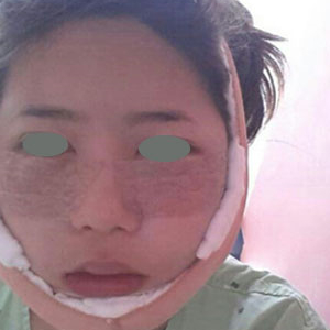 下頜角整形手術(shù)三個多月了，分享下我的恢復(fù)前后對比果圖片吧~