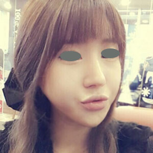 下頜角整形手術(shù)三個多月了，分享下我的恢復(fù)前后對比果圖片吧~