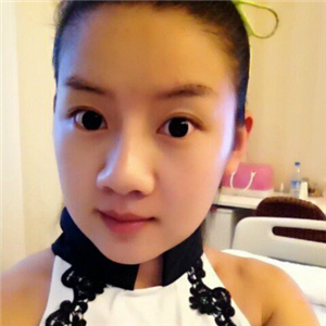 曬曬我做面部吸脂術(shù)前后對比果照片，中日友好高占巍做的哦~~