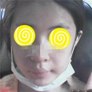 自體耳軟骨隆鼻手術(shù)恢復(fù)過(guò)程和前后對(duì)比圖分享，變化太大啦~~~