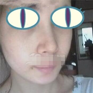 自體耳軟骨隆鼻手術(shù)恢復(fù)過(guò)程和前后對(duì)比圖分享，變化太大啦~~~