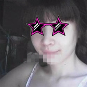 自體耳軟骨隆鼻手術(shù)恢復(fù)過(guò)程和前后對(duì)比圖分享，變化太大啦~~~