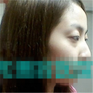 首爾麗格洪性范耳軟骨隆鼻案例