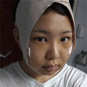 磨下頜角磨骨手術(shù)一個月了，分享一下恢復(fù)前后的果照片哇~
