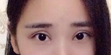 切開雙眼皮價格2680元，割雙眼皮拆線后圖片