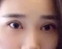 切開雙眼皮價格2680元，費用不貴果卻很好