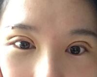 割雙眼皮過程恢復(fù)圖分享給大家，單眼皮變雙眼皮