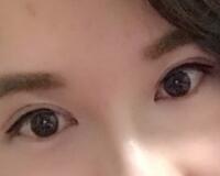 割雙眼皮過程恢復(fù)圖分享給大家，單眼皮變雙眼皮
