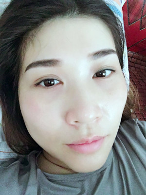 大家來評一下葛紅做的內切去眼袋怎么樣