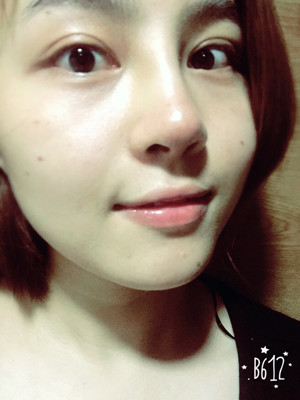 自體耳軟骨隆鼻后顏值上升了有沒有 莫琳娜葛紅做的