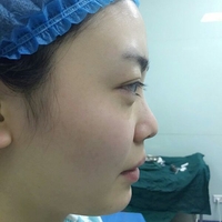 硅膠假體隆鼻后恢復(fù)得很漂亮下一步的目標(biāo)是自體脂肪全臉填充