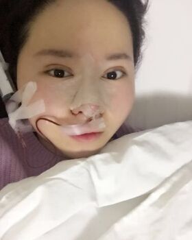路衛(wèi)國給我做隆鼻整形后鼻子變得特別秀麗