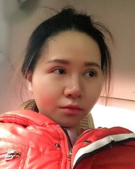 路衛(wèi)國給我做隆鼻整形后鼻子變得特別秀麗