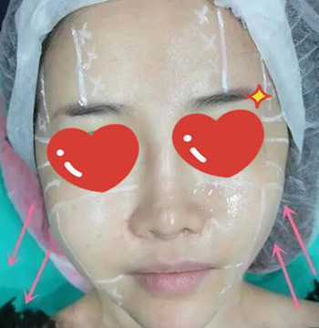 做了拉皮除皺 我的皮膚越來(lái)越緊致光滑了