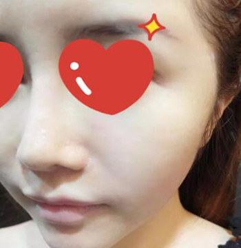 做了拉皮除皺 我的皮膚越來(lái)越緊致光滑了