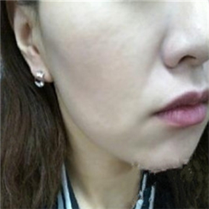 自體脂肪填充去法令紋一個(gè)星期了，分享我的恢復(fù)對(duì)比照片哦~~