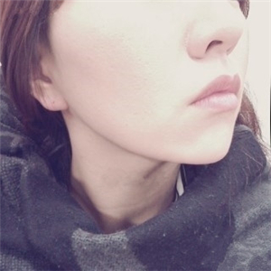 自體脂肪填充去法令紋一個(gè)星期了，分享我的恢復(fù)對(duì)比照片哦~~