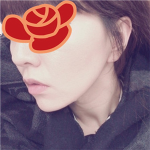 自體脂肪填充去法令紋一個(gè)星期了，分享我的恢復(fù)對(duì)比照片哦~~