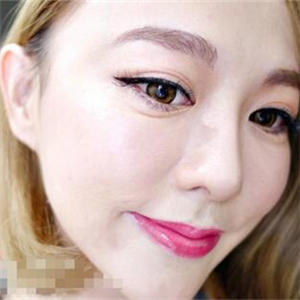 韓式埋線面b提拉一個(gè)月的果照片，前后對(duì)比差別有點(diǎn)大哦~