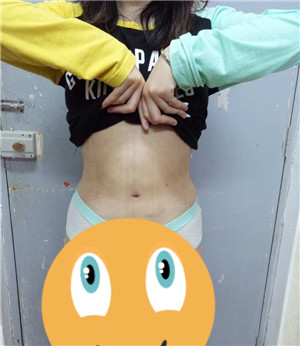 周長兵做的水動力吸脂瘦腰腹 大肚腩沒有了