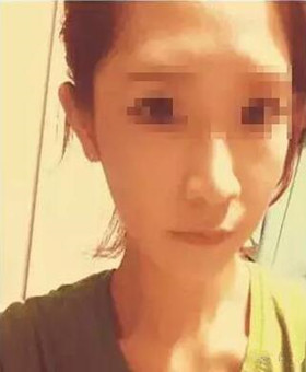 【20天康復記錄】隆鼻+面部脂肪填充，遇見更美的自己