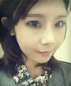 【20天康復記錄】隆鼻+面部脂肪填充，遇見更美的自己