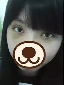 【真人案例】雙眼皮手術(shù)后，見證我的美!
