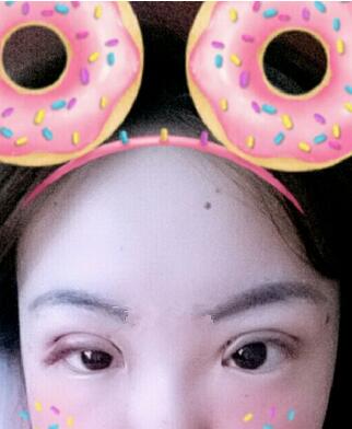雙眼皮恢復(fù)過程分享