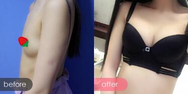 假體隆胸，假體隆胸價(jià)格為28000元