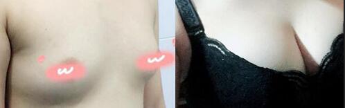 自體脂肪隆胸前后對比圖