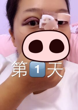 終于把雙眼皮割了，無錫菲尚張樹功做的