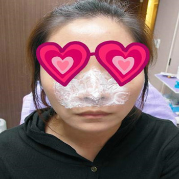 Misko隆鼻讓我鼻子變得挺拔嬌俏無(wú)壓力