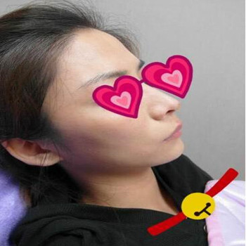 Misko隆鼻讓我鼻子變得挺拔嬌俏無(wú)壓力