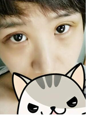 全切雙眼皮讓我躋身大眼一族