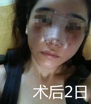 做了自體脂肪面部填充和隆鼻 整個(gè)面部都立體起來了