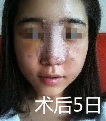做了自體脂肪面部填充和隆鼻 整個(gè)面部都立體起來了