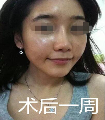 做了自體脂肪面部填充和隆鼻 整個(gè)面部都立體起來了