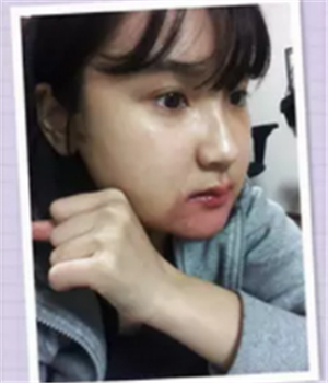 做了磨下頜角整形手術4個月了，曬曬我的恢復前后的對比照片吧~~