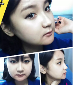 做了磨下頜角整形手術4個月了，曬曬我的恢復前后的對比照片吧~~