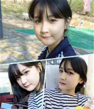 做了磨下頜角整形手術4個月了，曬曬我的恢復前后的對比照片吧~~