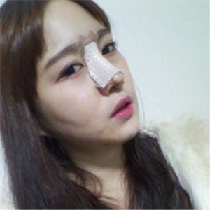 分享我改臉型+硅膠隆鼻手術前后對比果照片，伊萊美李湘源做的~