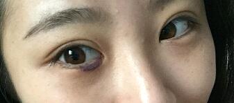 內(nèi)切祛眼袋手術(shù)恢復(fù)圖