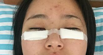 祛眼袋手術(shù)圖，恢復(fù)過程