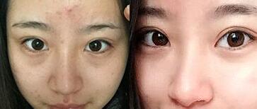祛眼袋前后對比圖