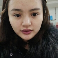 玻尿酸隆鼻花了兩萬多果很自然哦，值~！