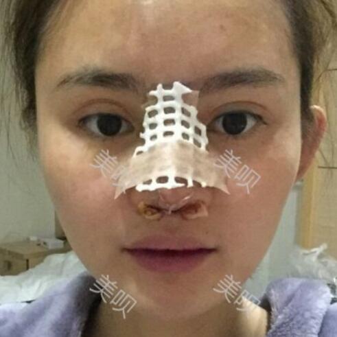 玻尿酸隆鼻花了兩萬多果很自然哦，值~！