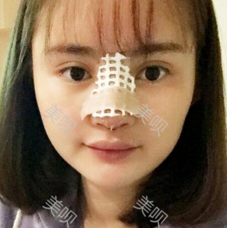 玻尿酸隆鼻花了兩萬多果很自然哦，值~！