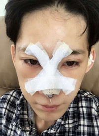 深圳廣和尹衛(wèi)民做的隆鼻整形，大家來看看果