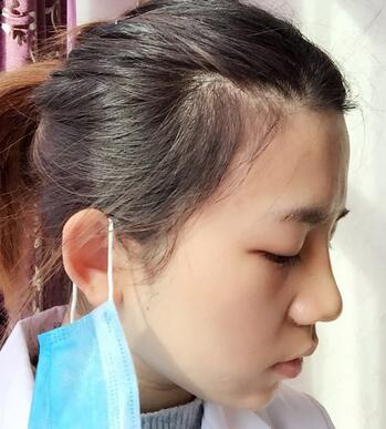 長(zhǎng)沙美之峰假體隆鼻恢復(fù)日記