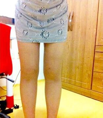 吸脂瘦大腿讓我夏天放肆(｡･∀･)ﾉﾞ